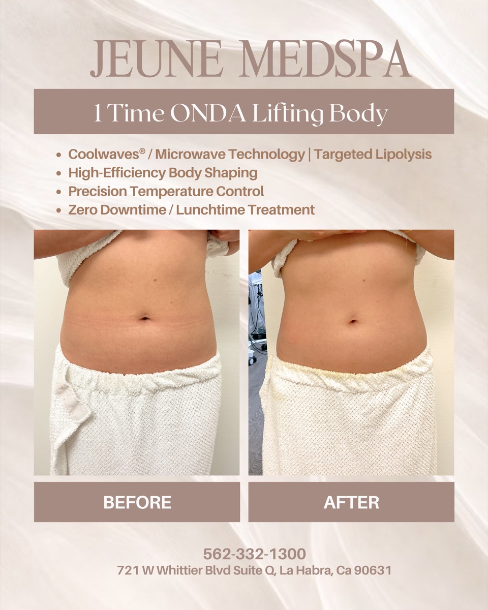 ONDA Body Lifting — 1 Session — before and after at Jeune Medspa La Habra