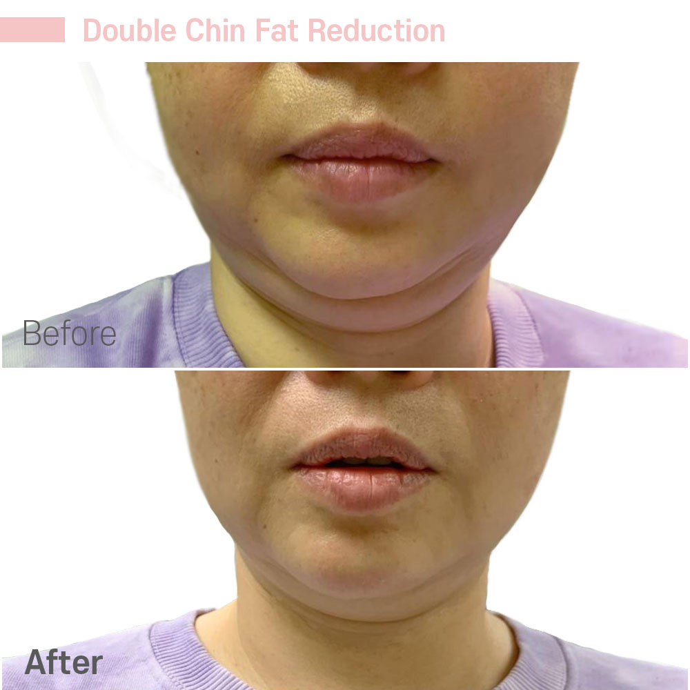 Double Chin Fat Reduction — before and after at Jeune Medspa La Habra