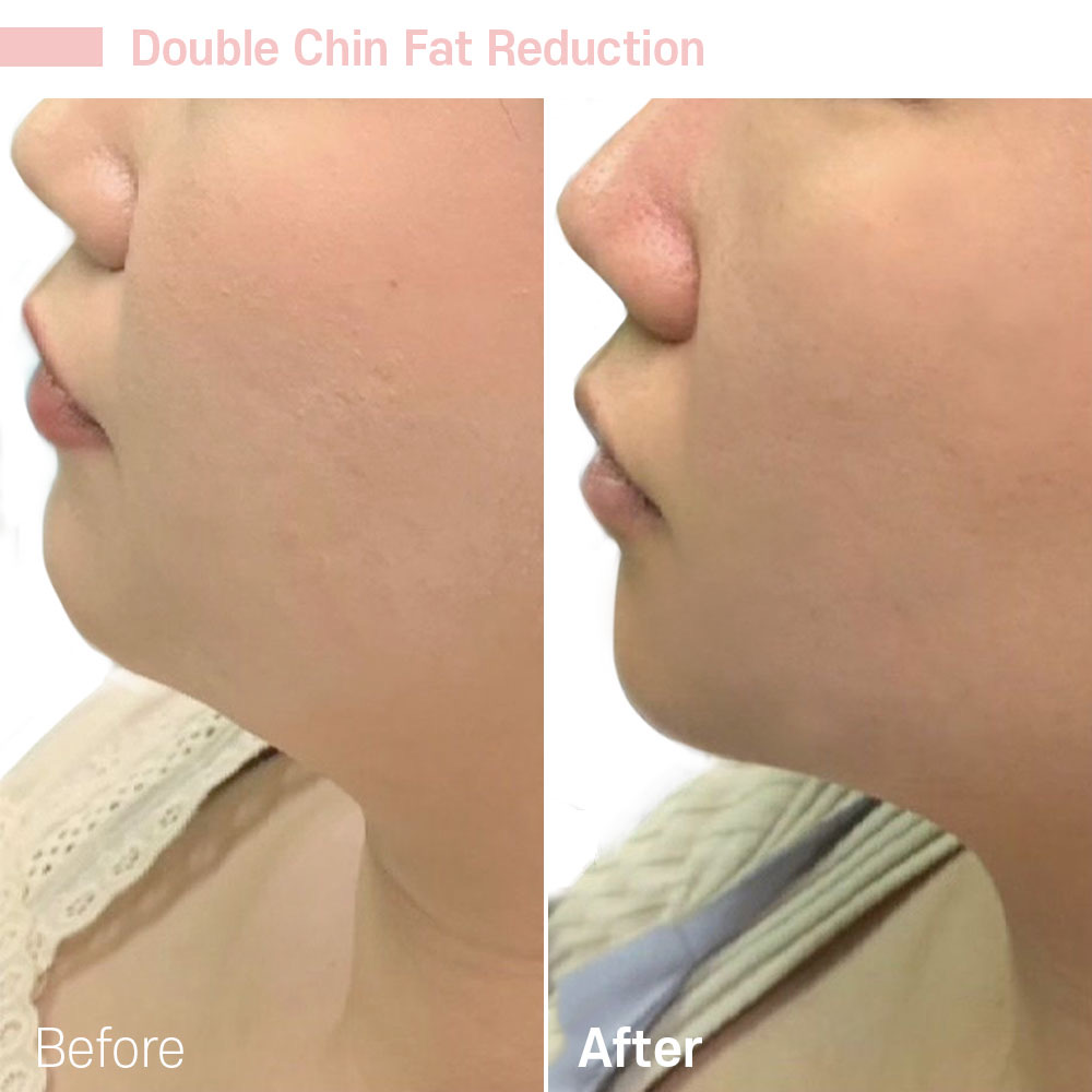 Double Chin Fat Reduction — before and after at Jeune Medspa La Habra