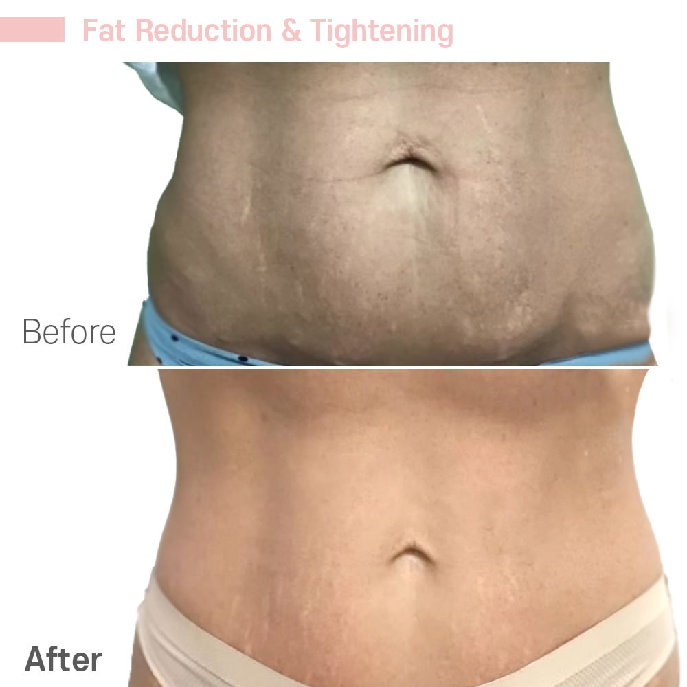 Fat Reduction & Tightening — before and after at Jeune Medspa La Habra