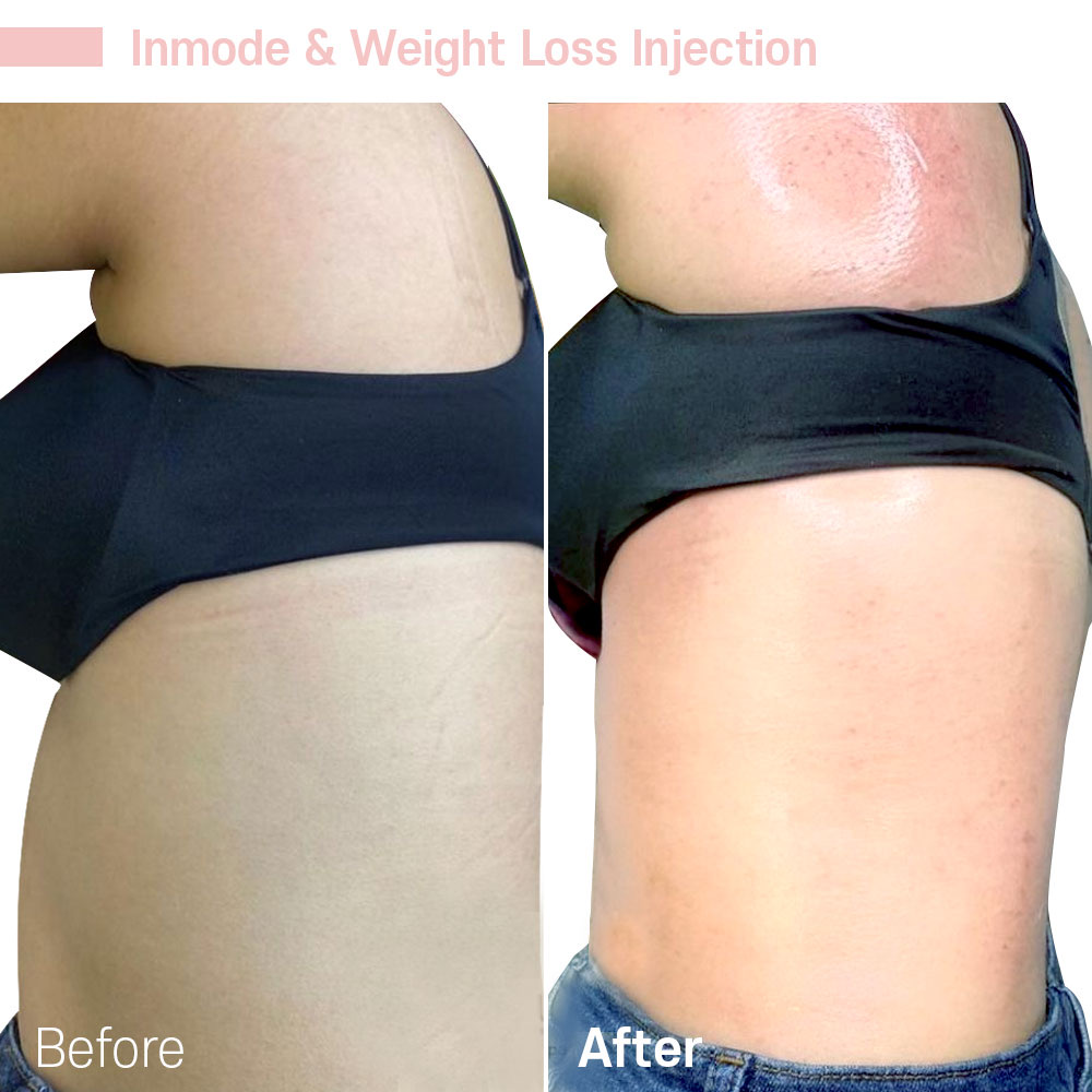 Inmode & Weight Loss Injection — before and after at Jeune Medspa La Habra