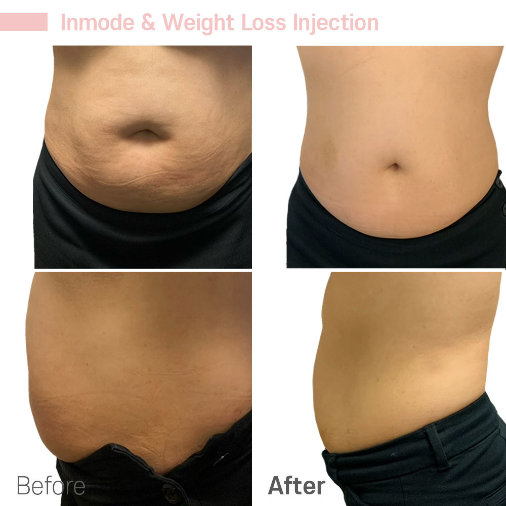 Inmode & Weight Loss Injection — before and after at Jeune Medspa La Habra