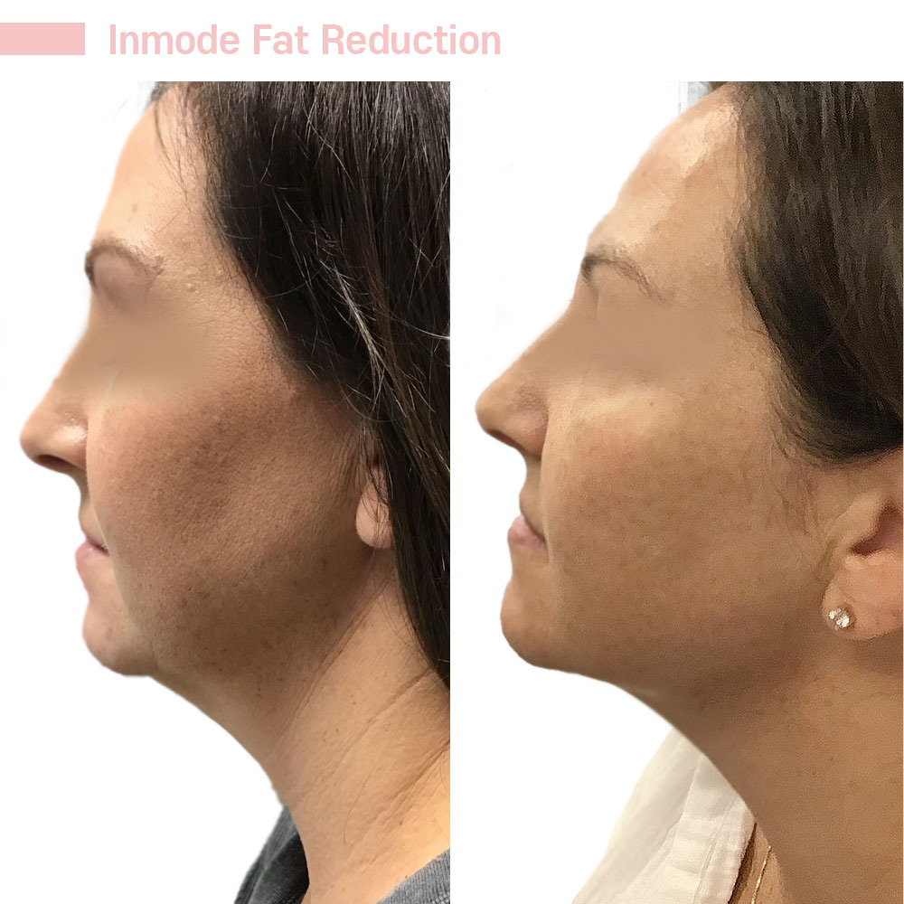 Inmode Fat Reduction — before and after at Jeune Medspa La Habra
