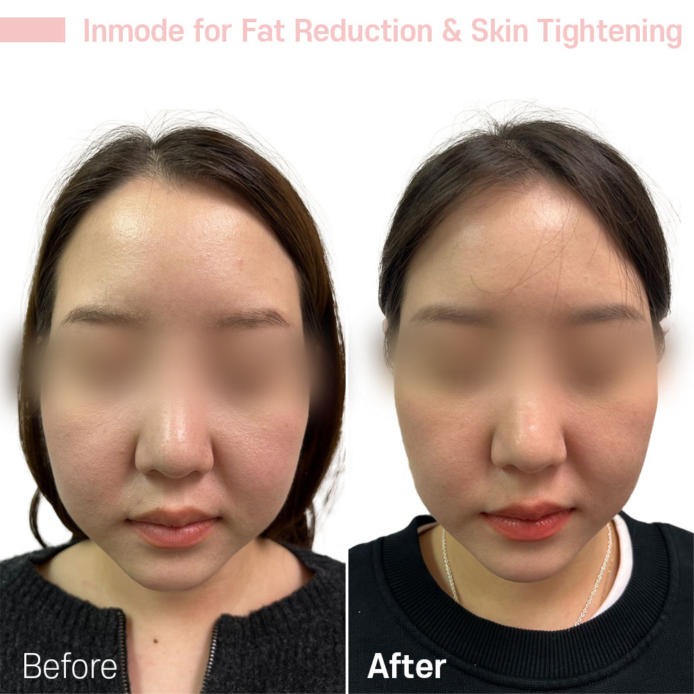 Inmode for Fat Reduction & Skin Tightening — before and after at Jeune Medspa La Habra