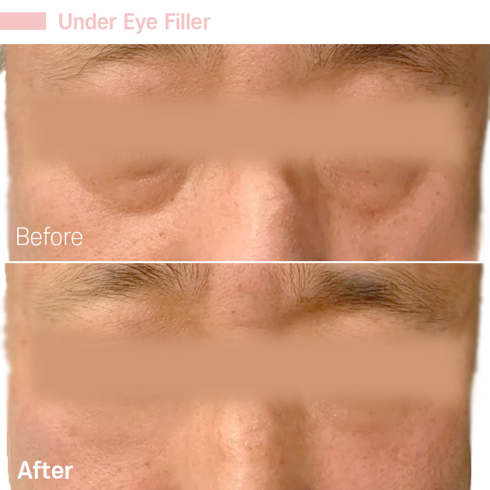 Under Eye Filler — before and after at Jeune Medspa La Habra