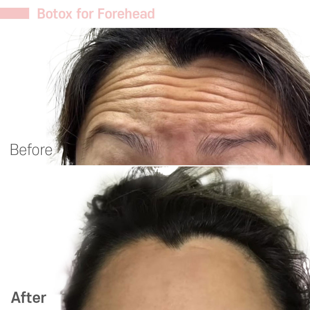 Botox for Forehead — before and after at Jeune Medspa La Habra