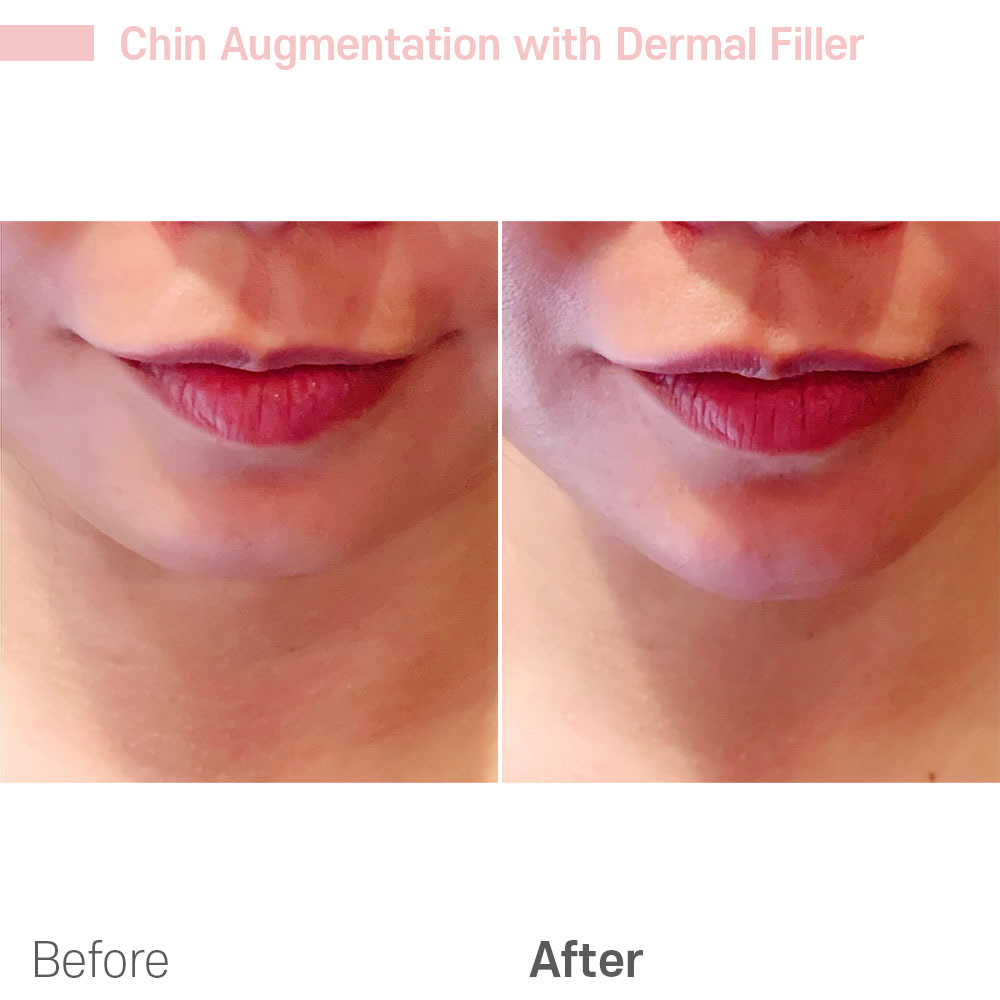 Chin Augmentation with Dermal Filler — before and after at Jeune Medspa La Habra