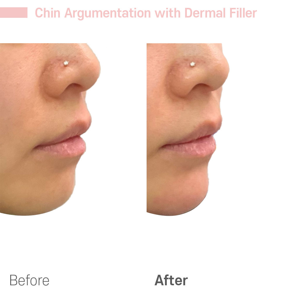 Chin Augmentation with Dermal Filler — before and after at Jeune Medspa La Habra