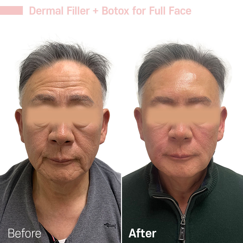 Dermal Filler + Botox for Full Face — before and after at Jeune Medspa La Habra