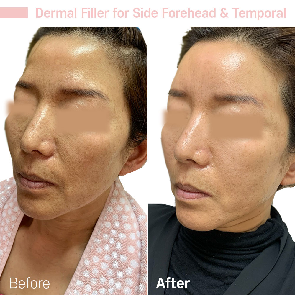 Dermal Filler for Side Forehead & Temporal — before and after at Jeune Medspa La Habra
