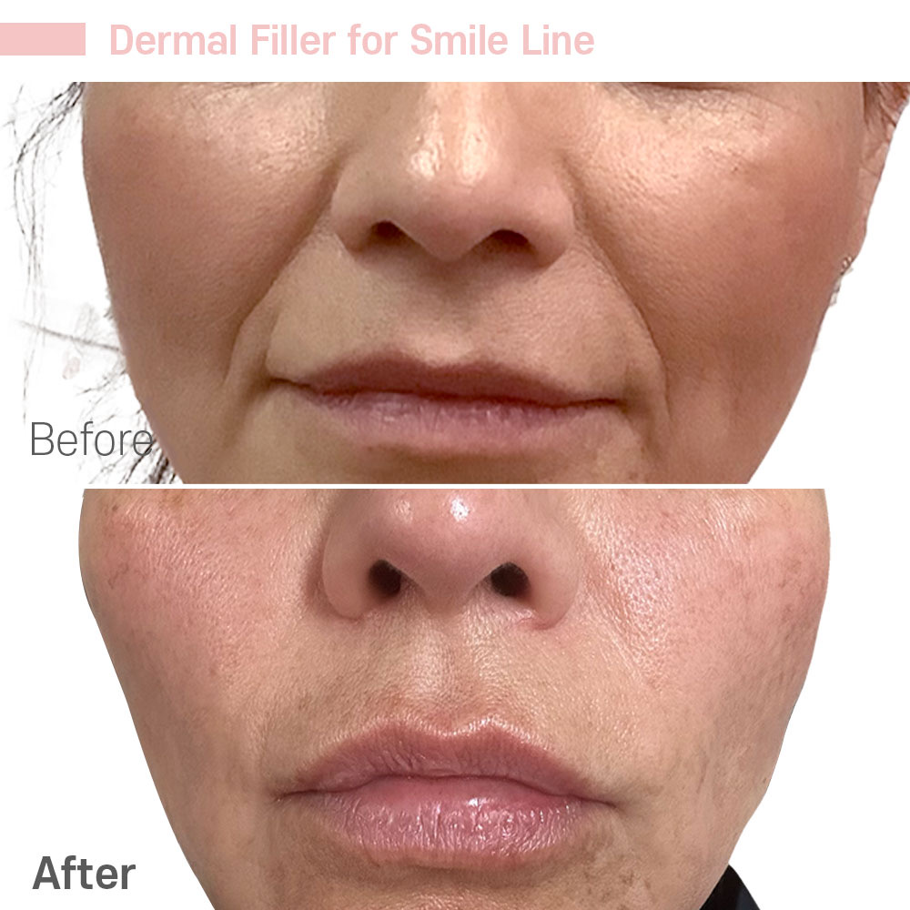 Dermal Filler for Smile Line — before and after at Jeune Medspa La Habra