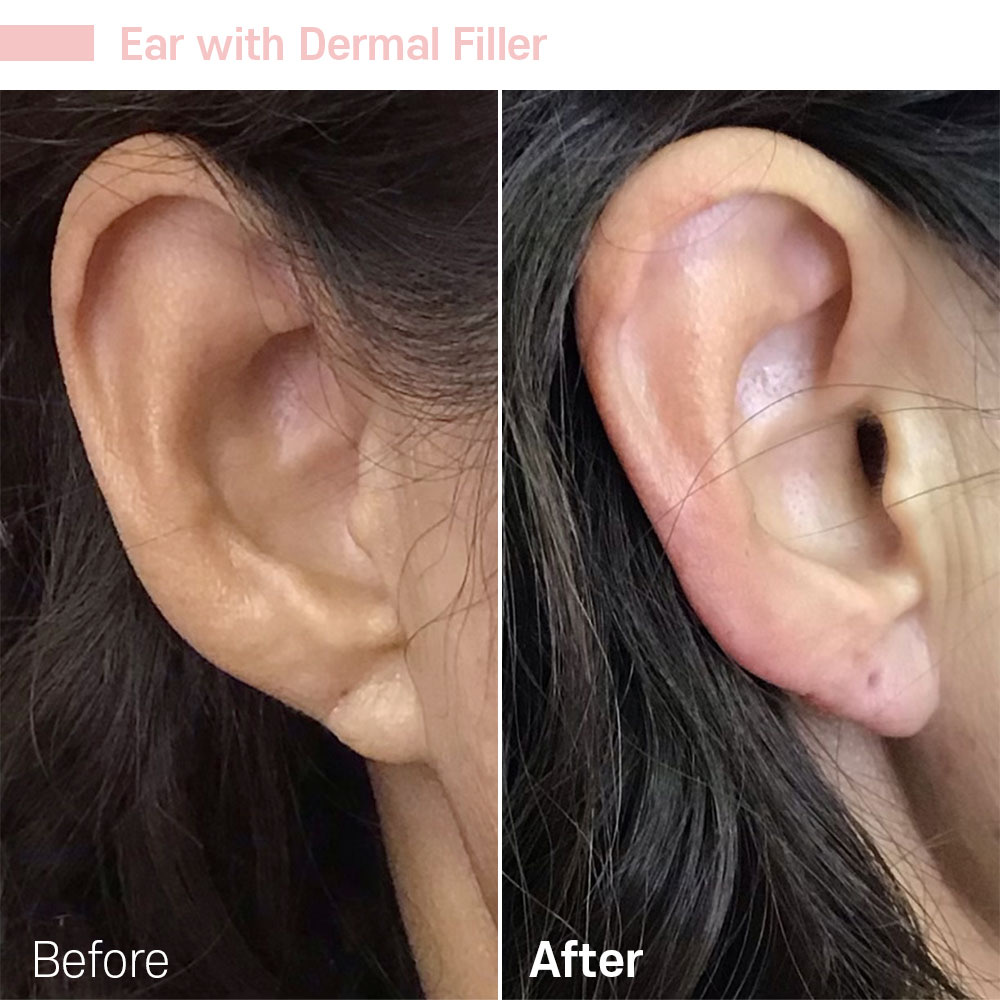 Ear with Dermal Filler — before and after at Jeune Medspa La Habra