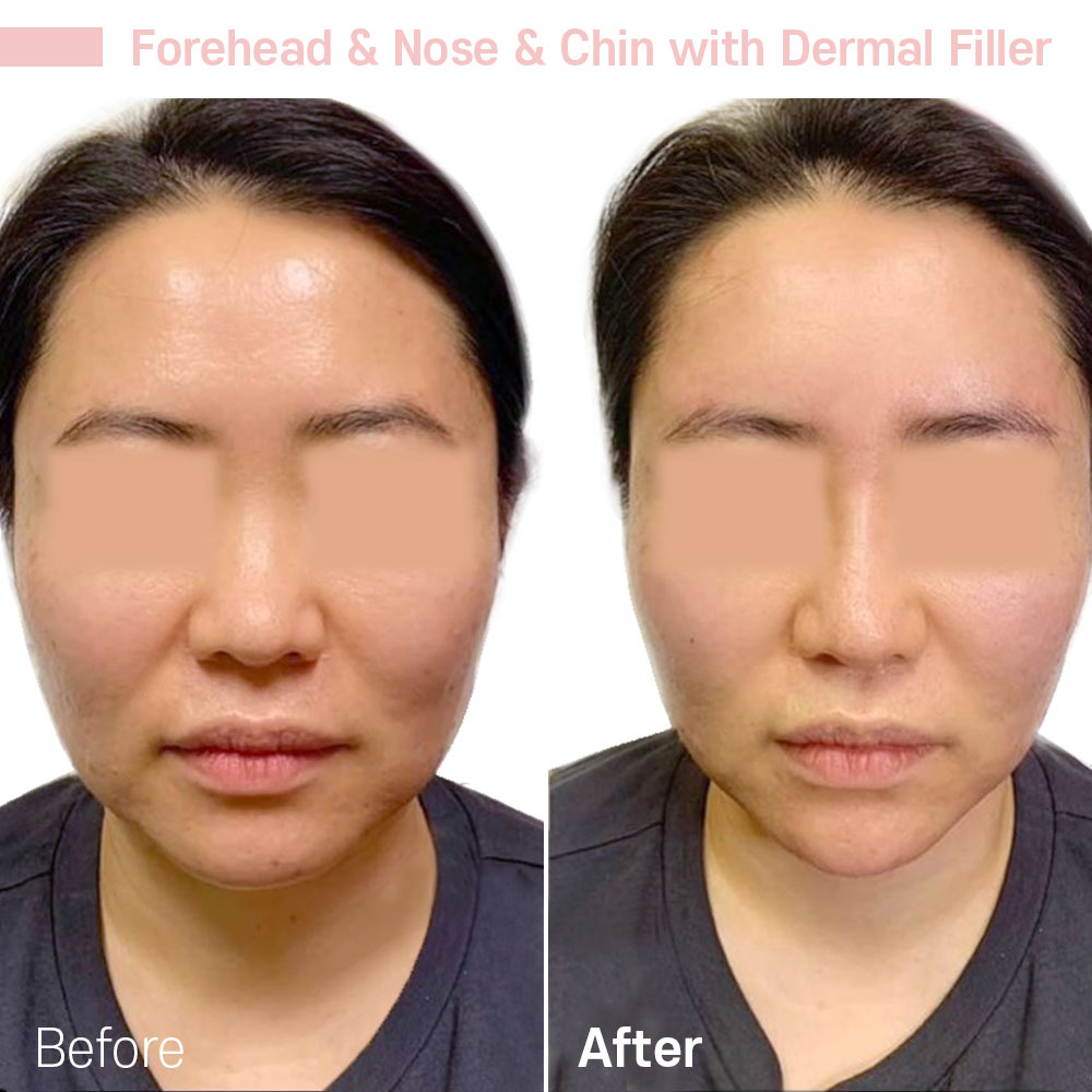 Forehead & Nose & Chin with Dermal Filler — before and after at Jeune Medspa La Habra