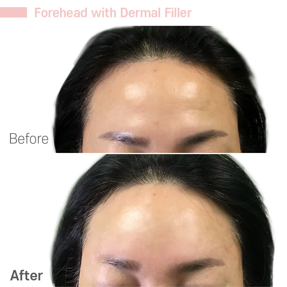 Forehead with Dermal Filler — before and after at Jeune Medspa La Habra