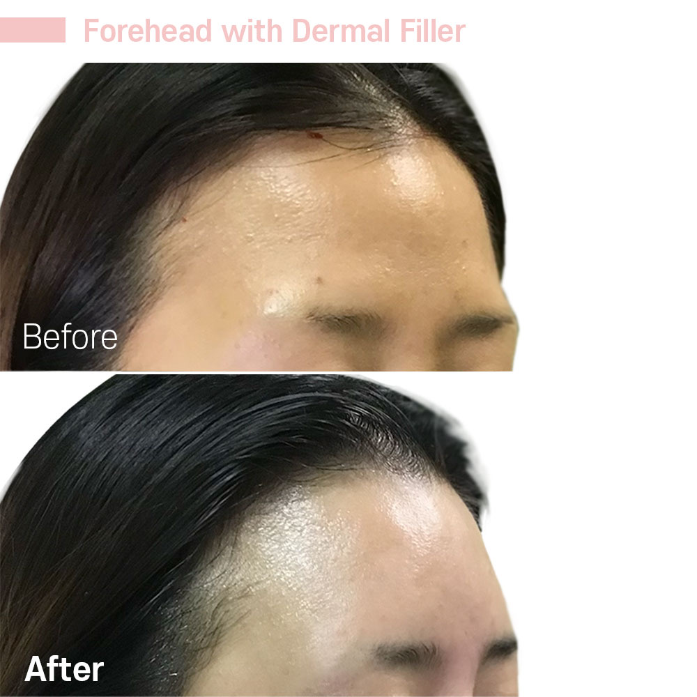 Forehead with Dermal Filler — before and after at Jeune Medspa La Habra