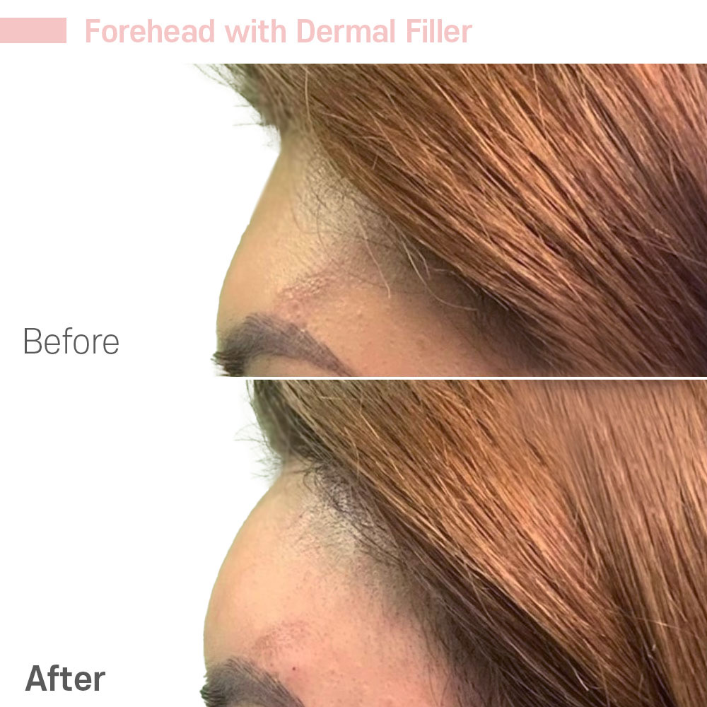 Forehead with Dermal Filler — before and after at Jeune Medspa La Habra