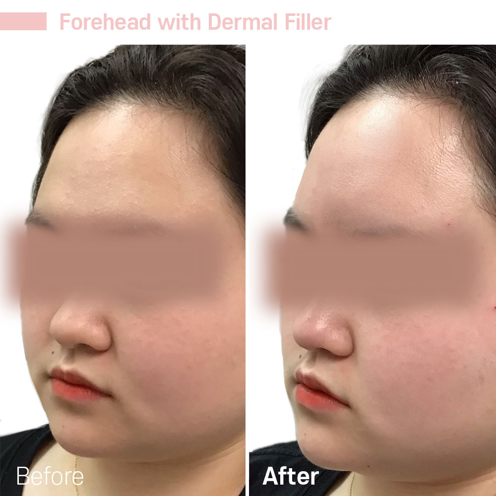Forehead with Dermal Filler — before and after at Jeune Medspa La Habra