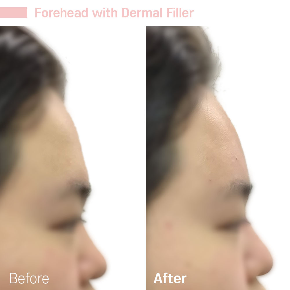 Forehead with Dermal Filler — before and after at Jeune Medspa La Habra