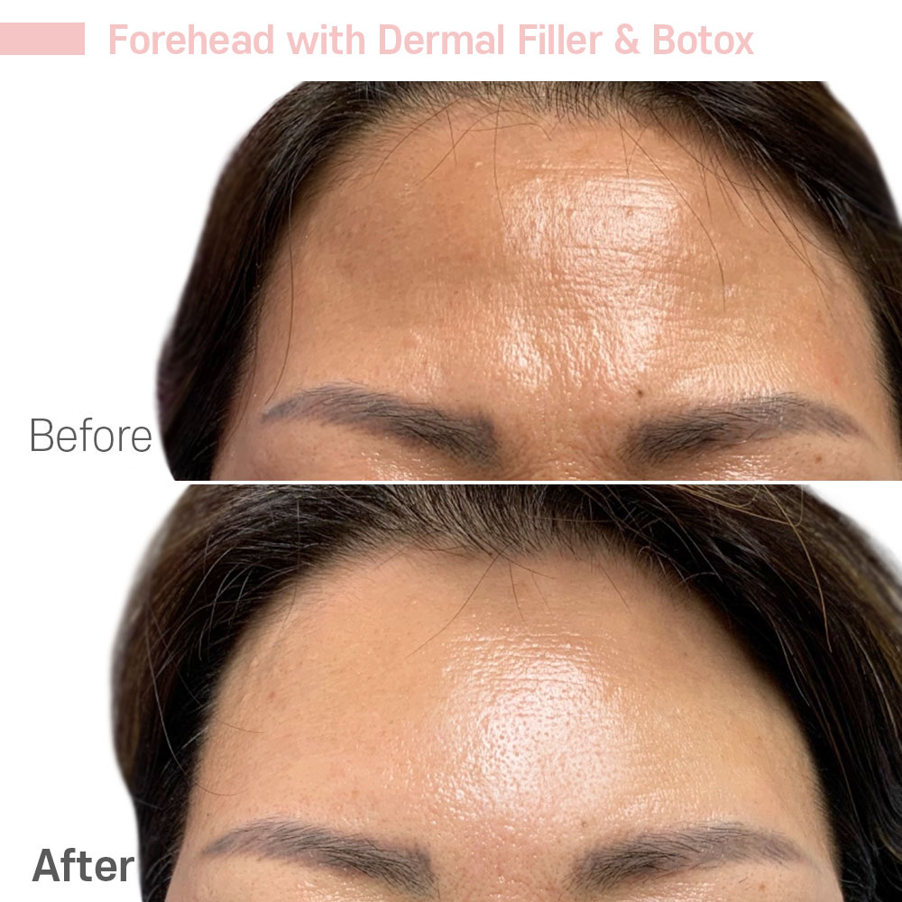Forehead with Dermal Filler & Botox — before and after at Jeune Medspa La Habra