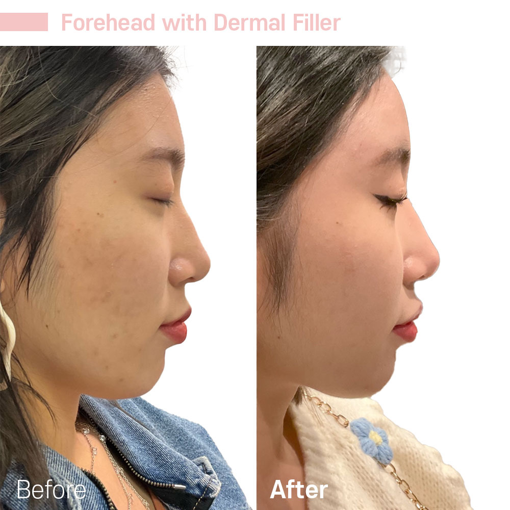 Forehead with Dermal Filler — before and after at Jeune Medspa La Habra