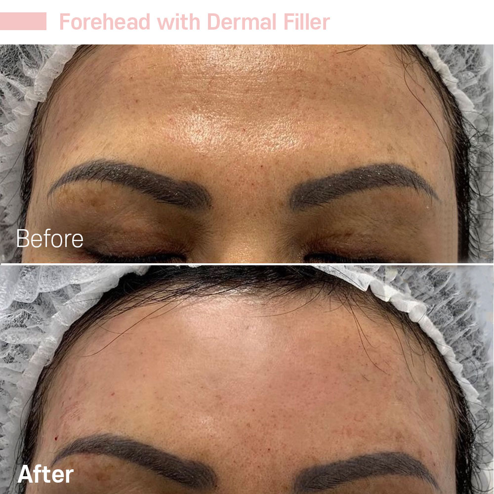 Forehead with Dermal Filler — before and after at Jeune Medspa La Habra