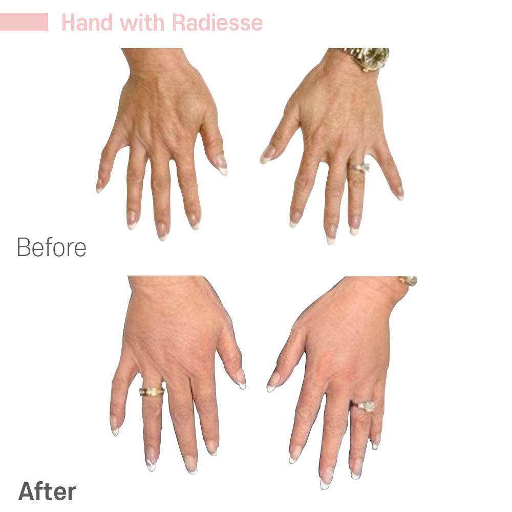 Hand with Radiesse — before and after at Jeune Medspa La Habra