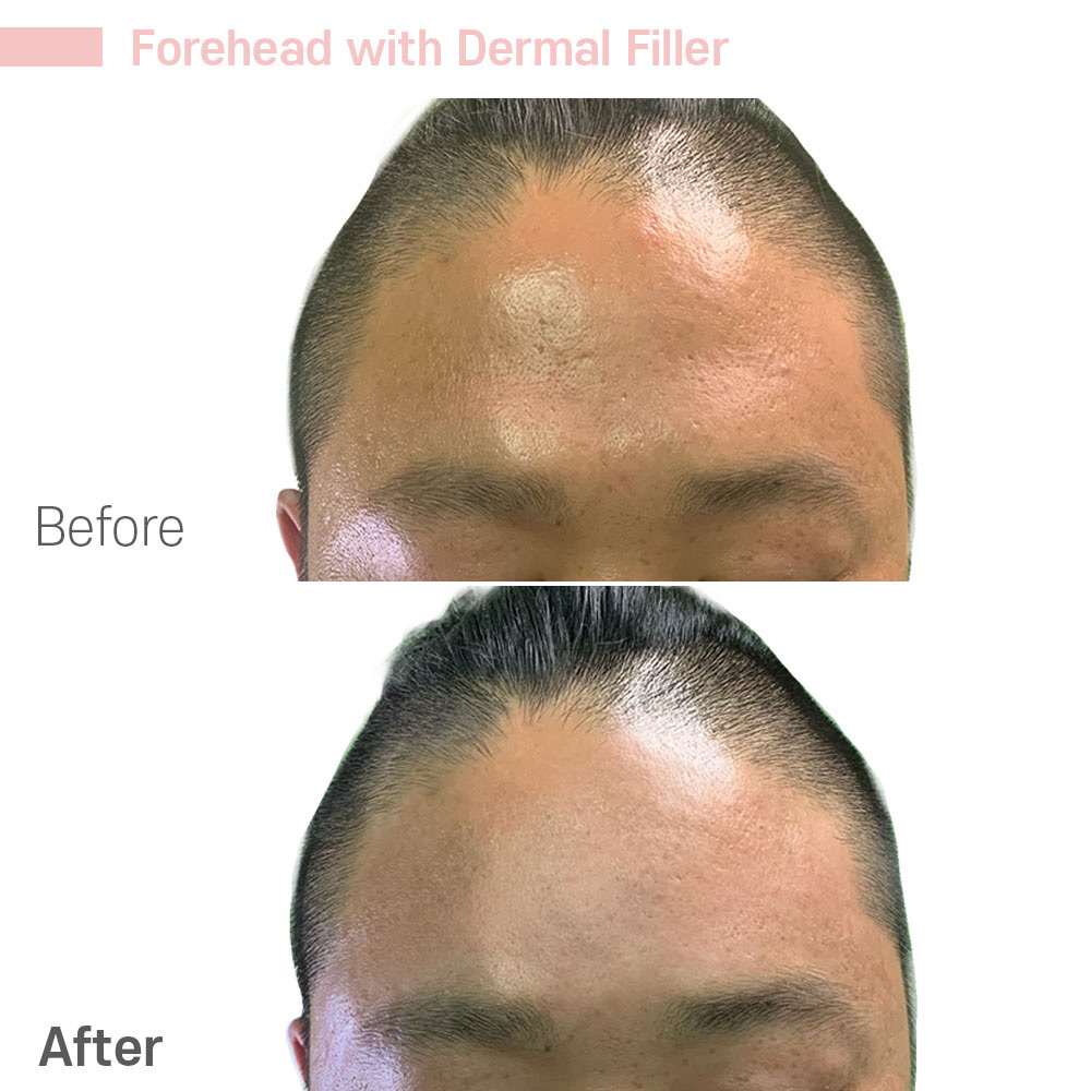 Forehead with Dermal Filler — before and after at Jeune Medspa La Habra
