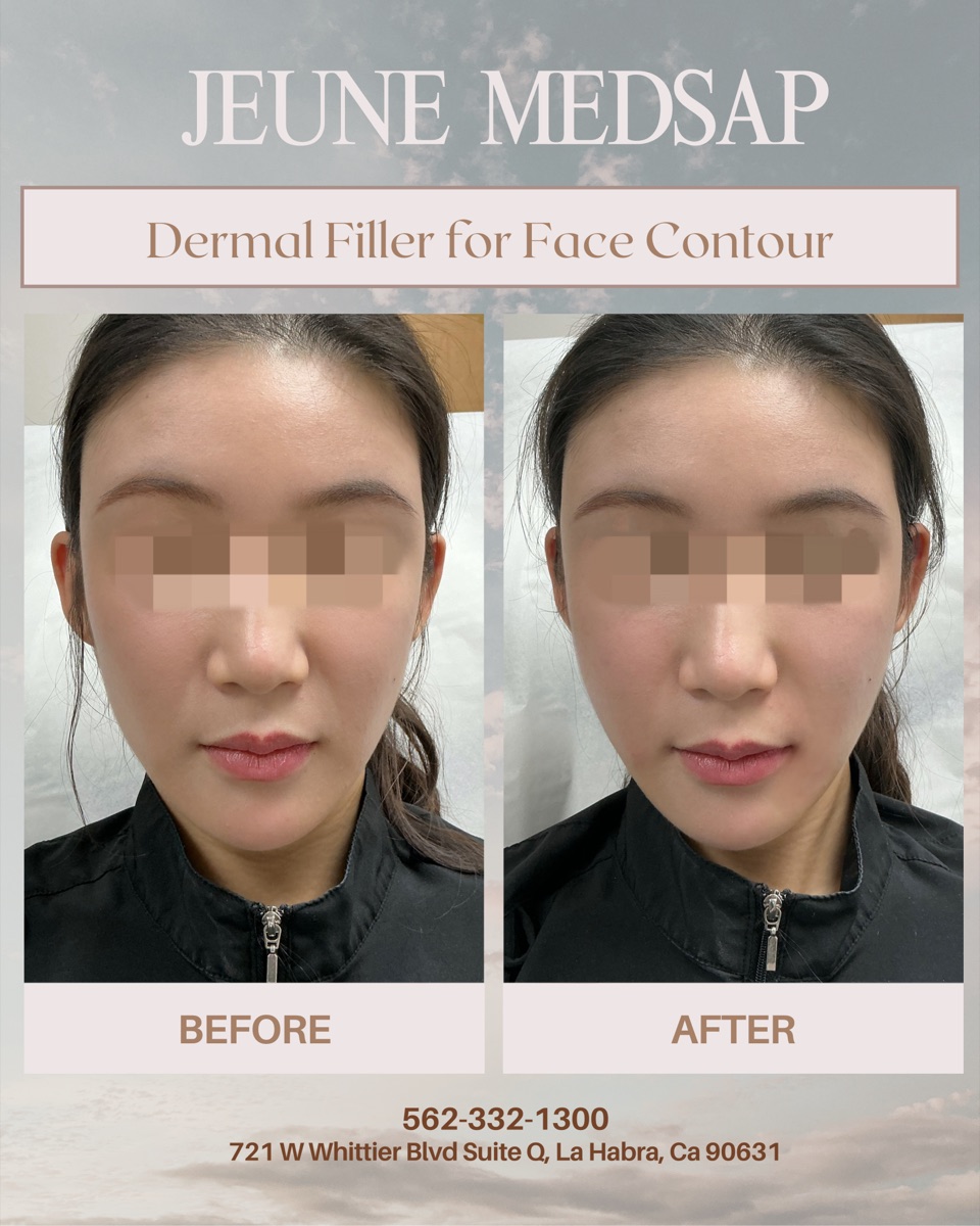 Dermal Filler for Face Contour — before and after at Jeune Medspa La Habra