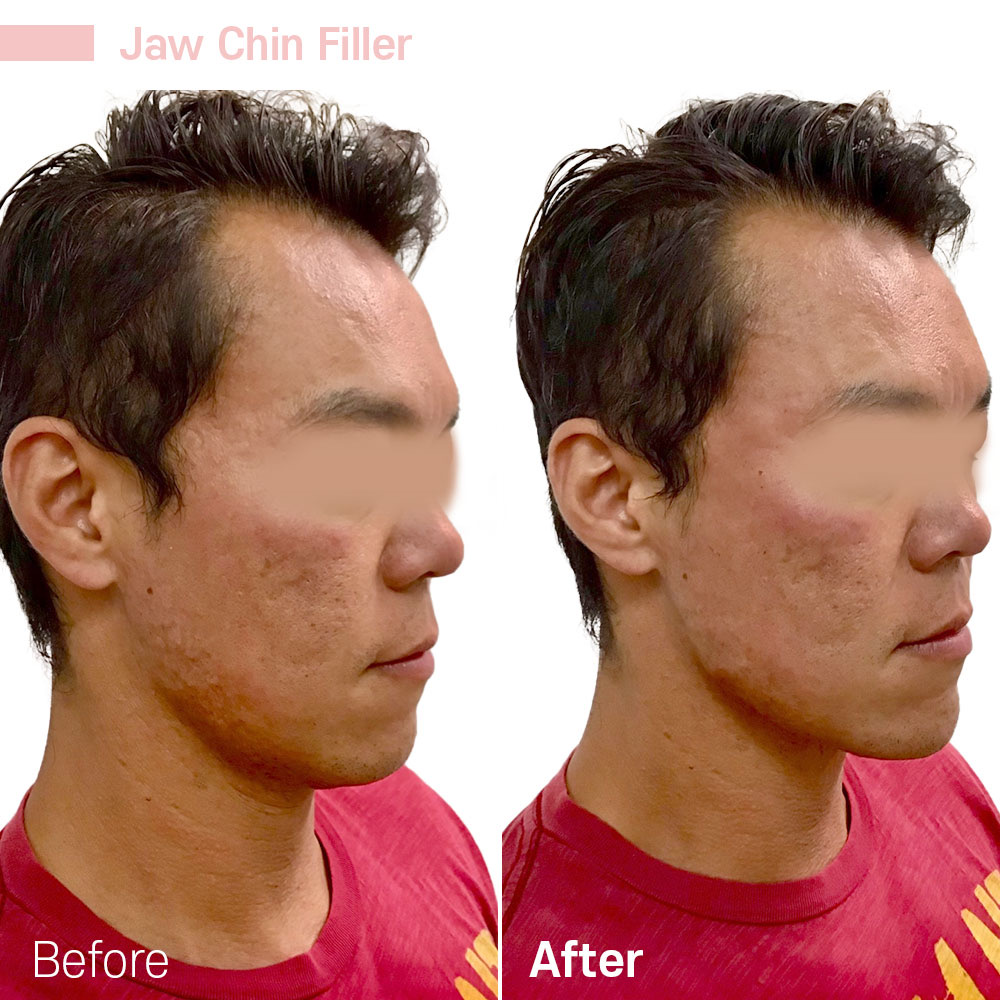 Jaw Chin Filler — before and after at Jeune Medspa La Habra