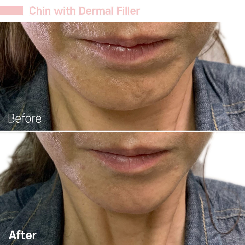 Chin with Dermal Filler — before and after at Jeune Medspa La Habra