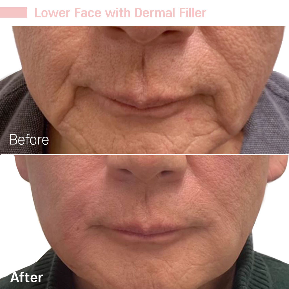 Lower Face with Dermal Filler — before and after at Jeune Medspa La Habra