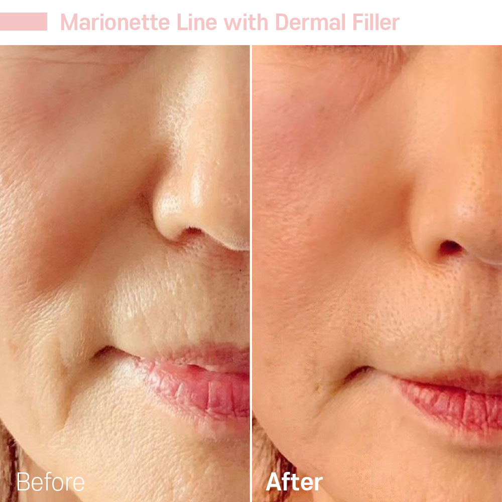 Marionette Line with Dermal Filler — before and after at Jeune Medspa La Habra