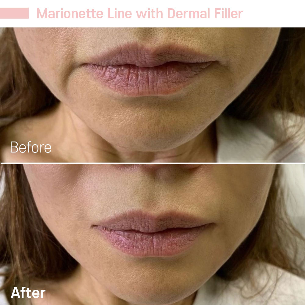 Marionette Line with Dermal Filler — before and after at Jeune Medspa La Habra