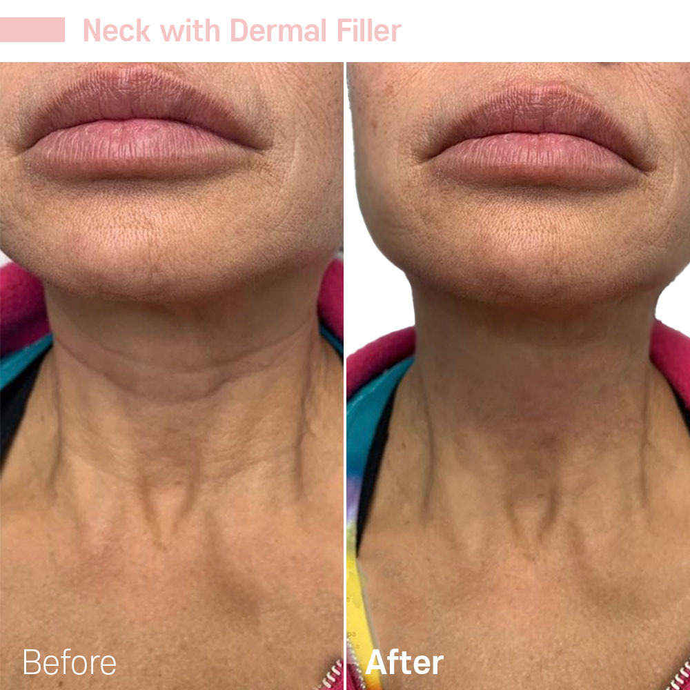 Neck with Dermal Filler — before and after at Jeune Medspa La Habra