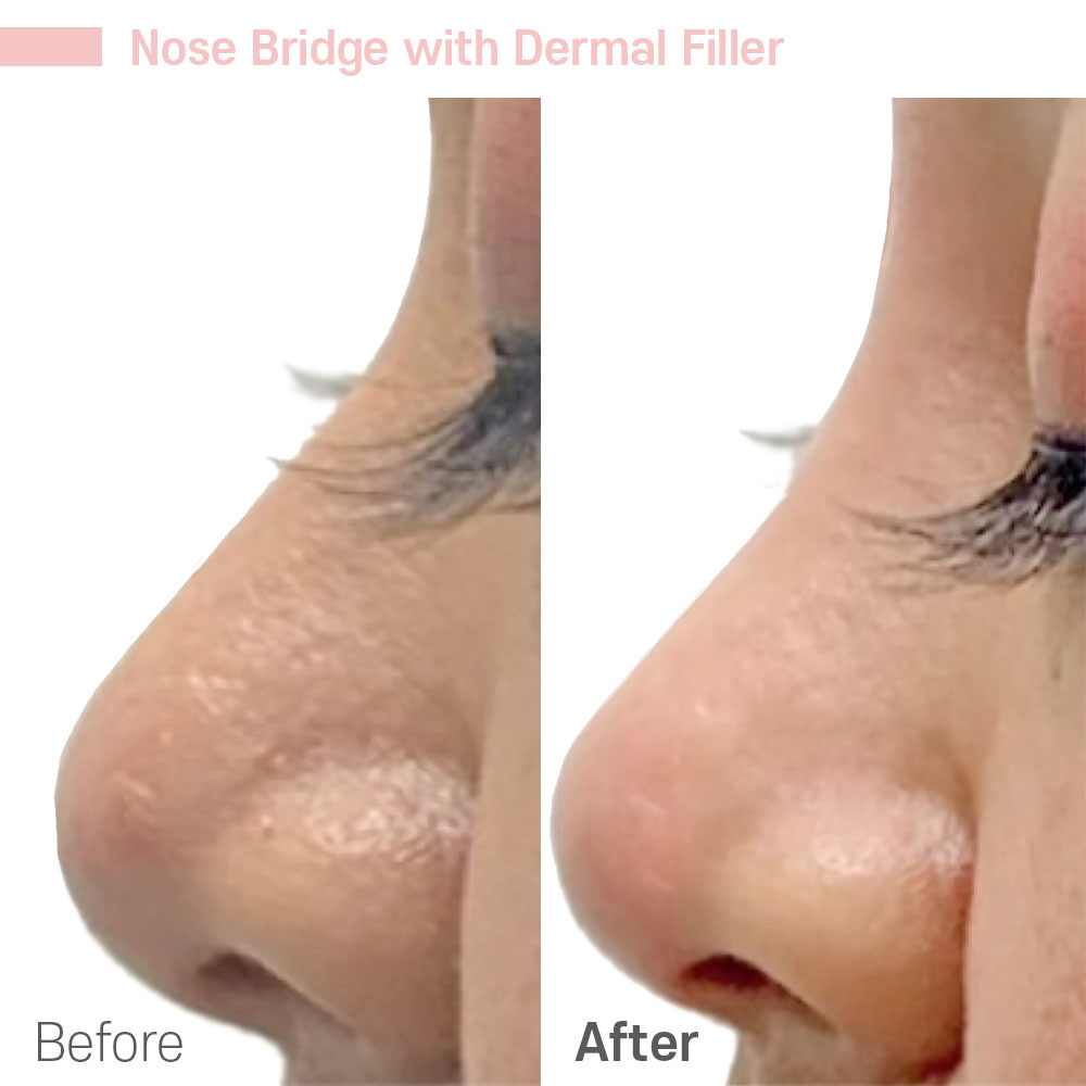 Nose Bridge with Dermal Filler — before and after at Jeune Medspa La Habra