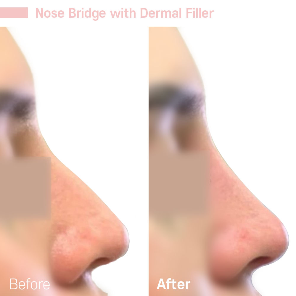 Nose Bridge with Dermal Filler — before and after at Jeune Medspa La Habra