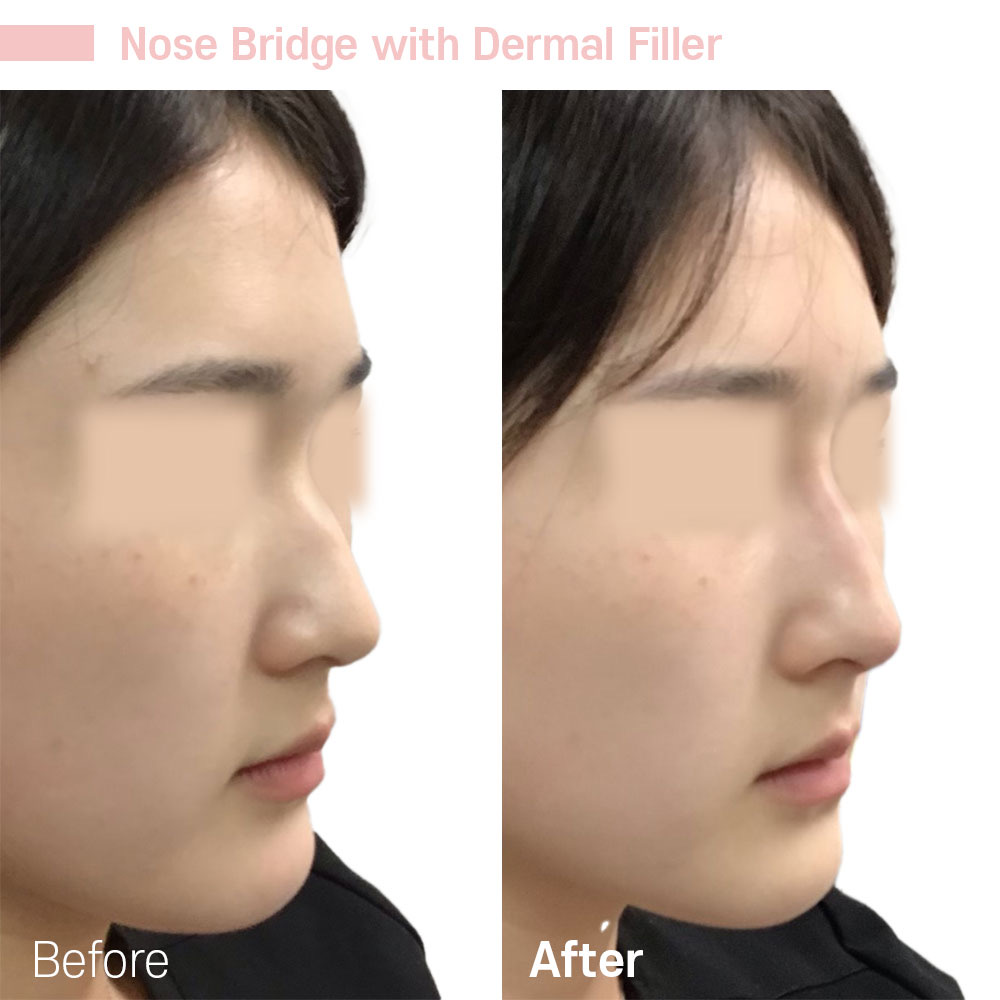 Nose Bridge with Dermal Filler — before and after at Jeune Medspa La Habra