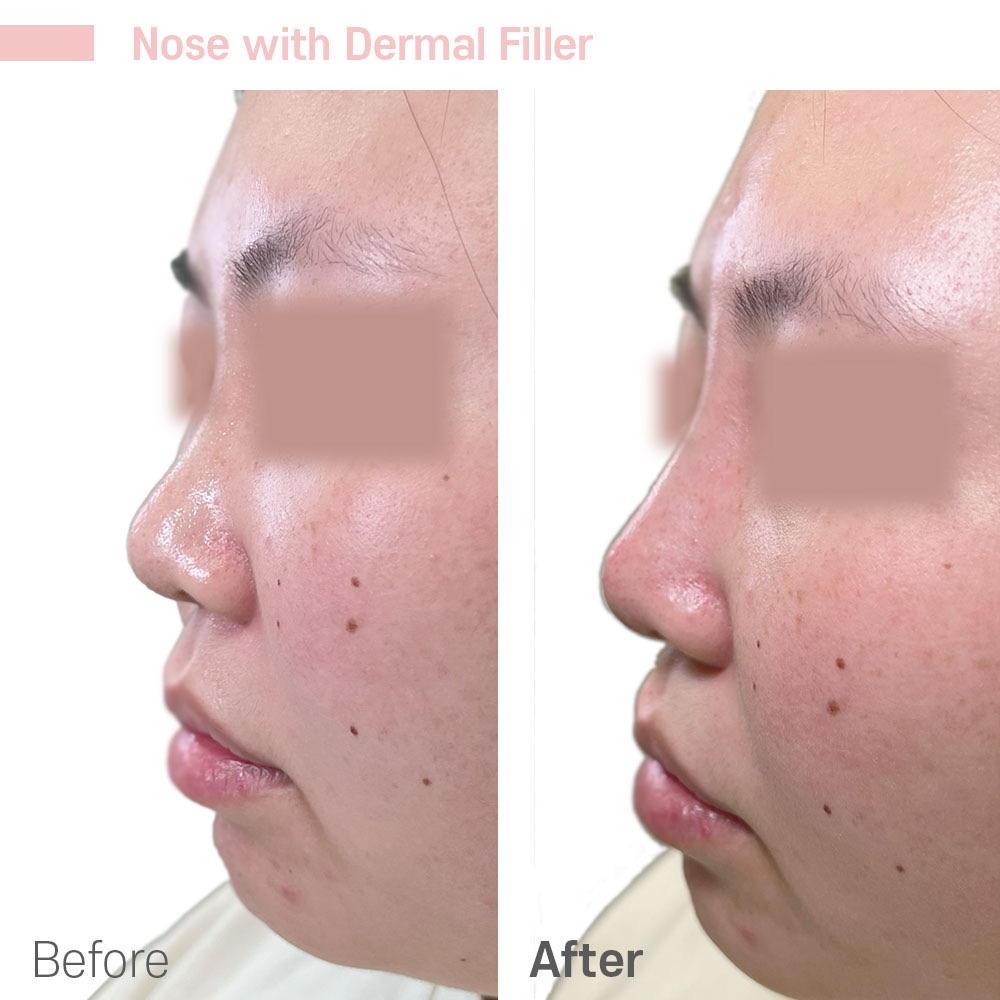 Nose with Dermal Filler — before and after at Jeune Medspa La Habra