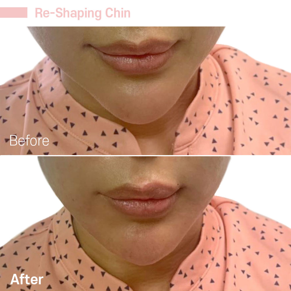 Re-Shaping Chin — before and after at Jeune Medspa La Habra