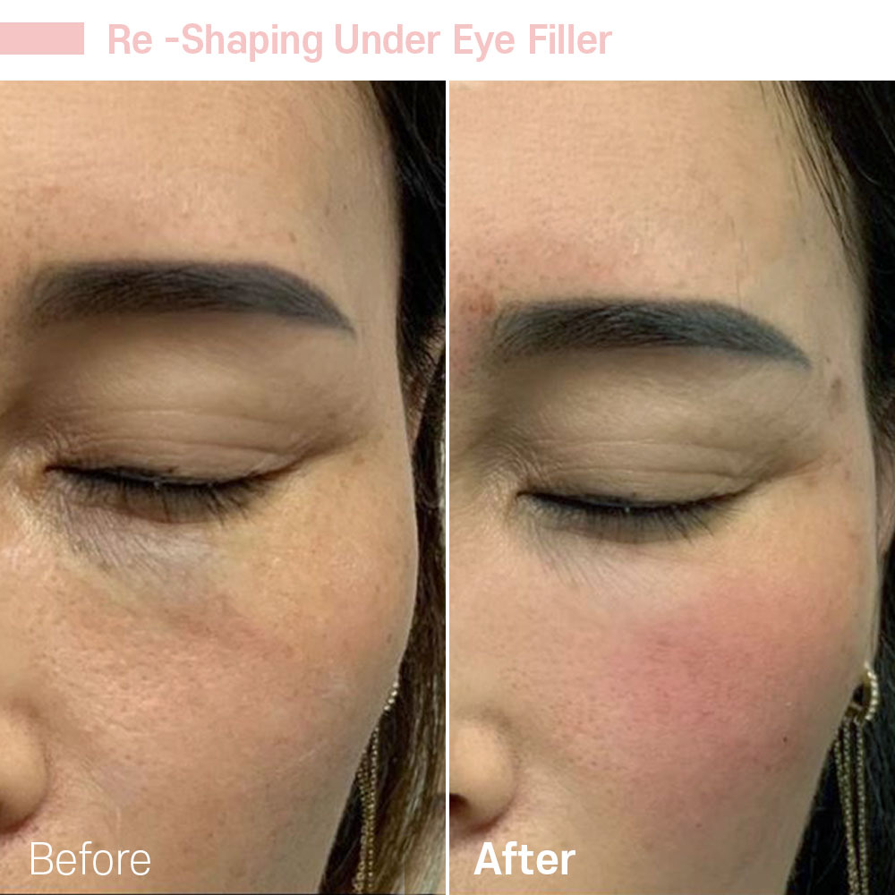 Re-Shaping Under Eye Filler — before and after at Jeune Medspa La Habra