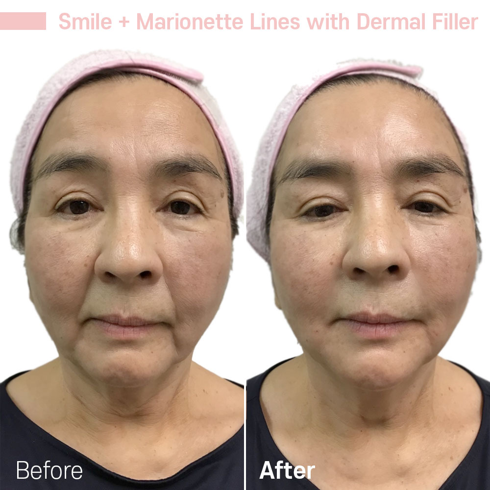 Smile + Marionette Lines with Dermal Filler — before and after at Jeune Medspa La Habra