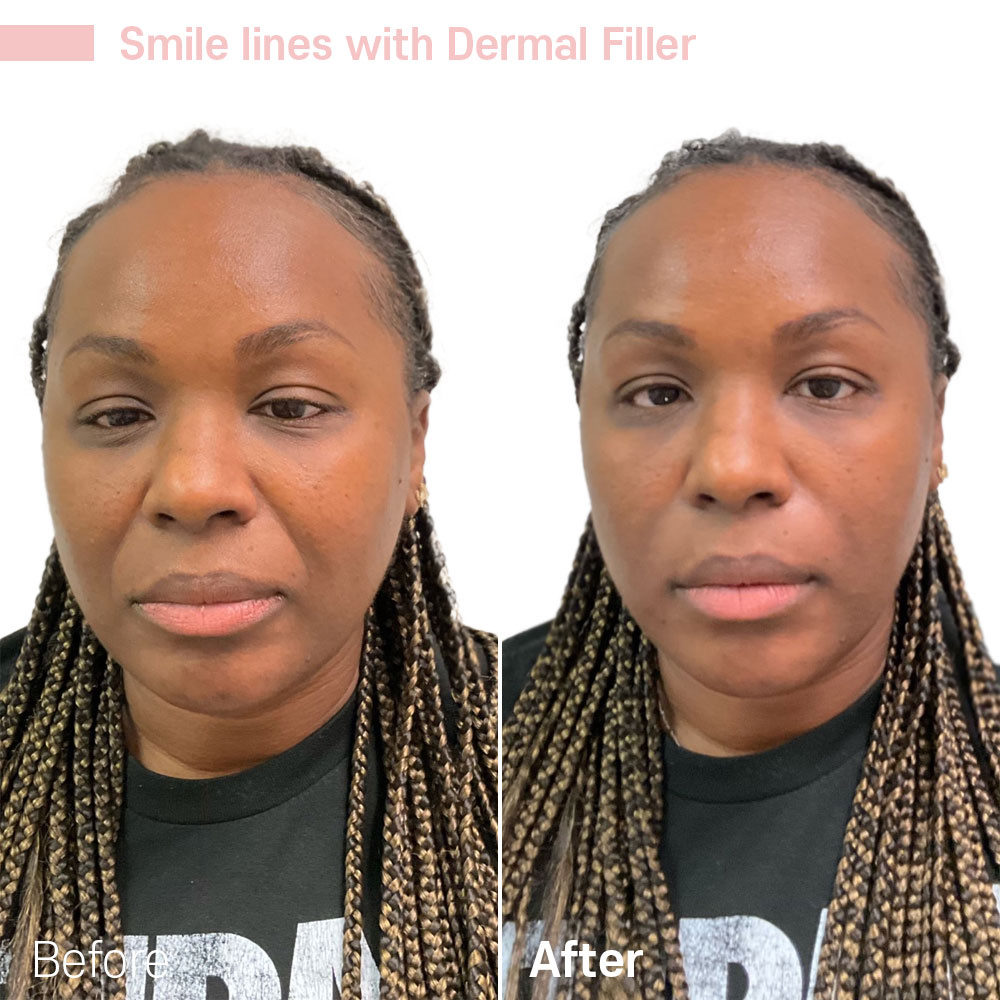 Smile Lines with Dermal Filler — before and after at Jeune Medspa La Habra