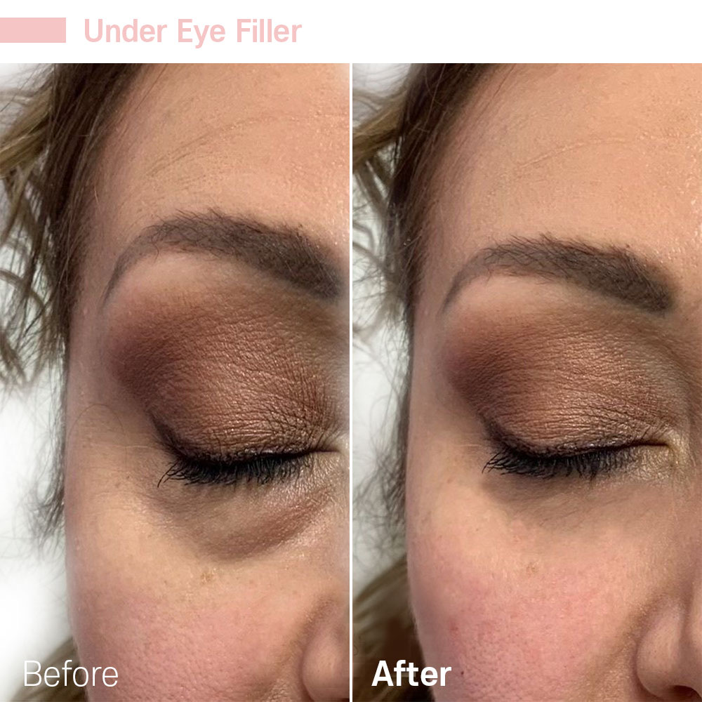 Under Eye Filler — before and after at Jeune Medspa La Habra