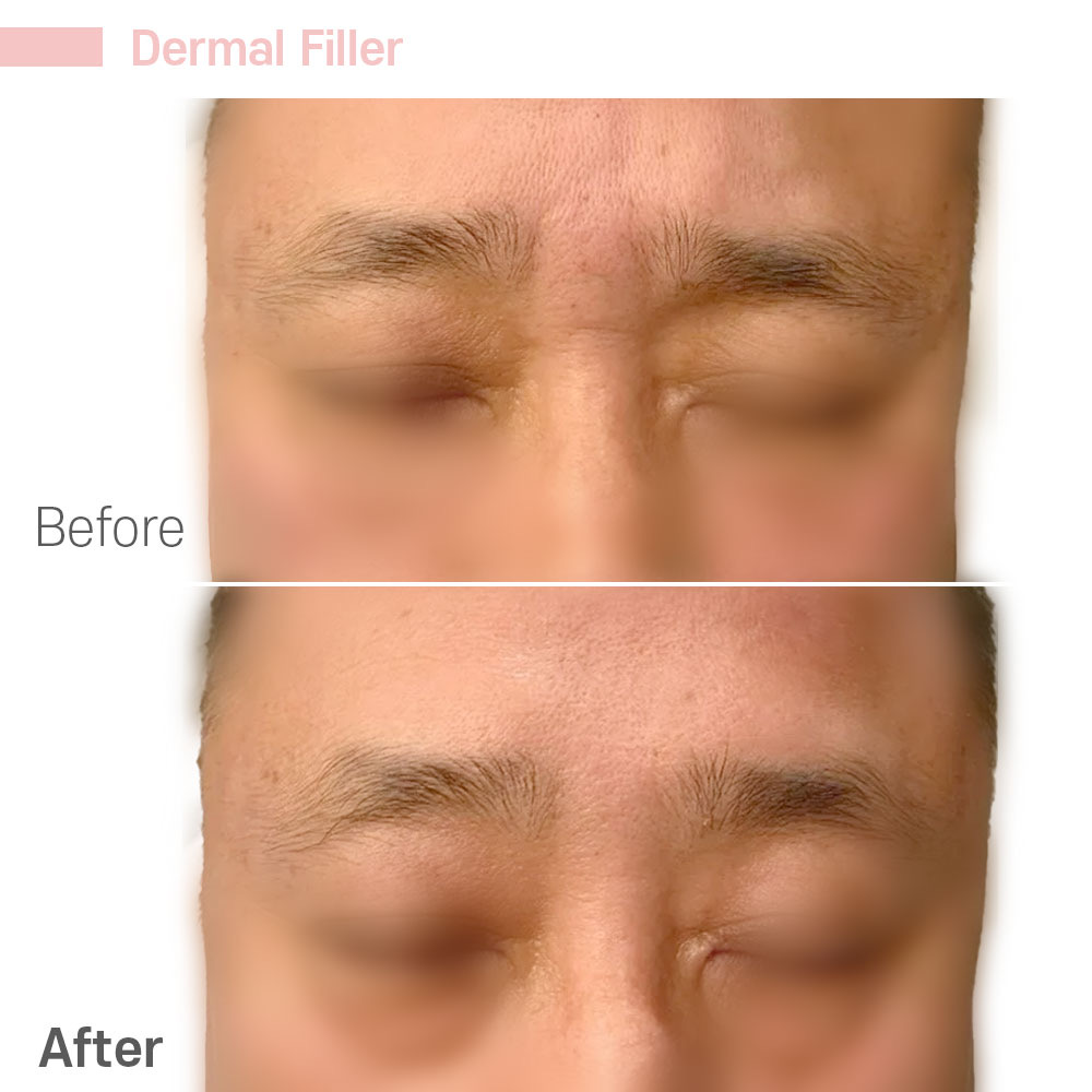 Dermal Filler — before and after at Jeune Medspa La Habra