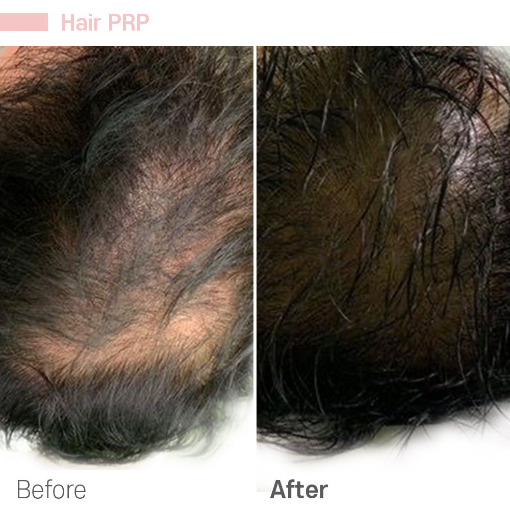 Hair PRP — before and after at Jeune Medspa La Habra