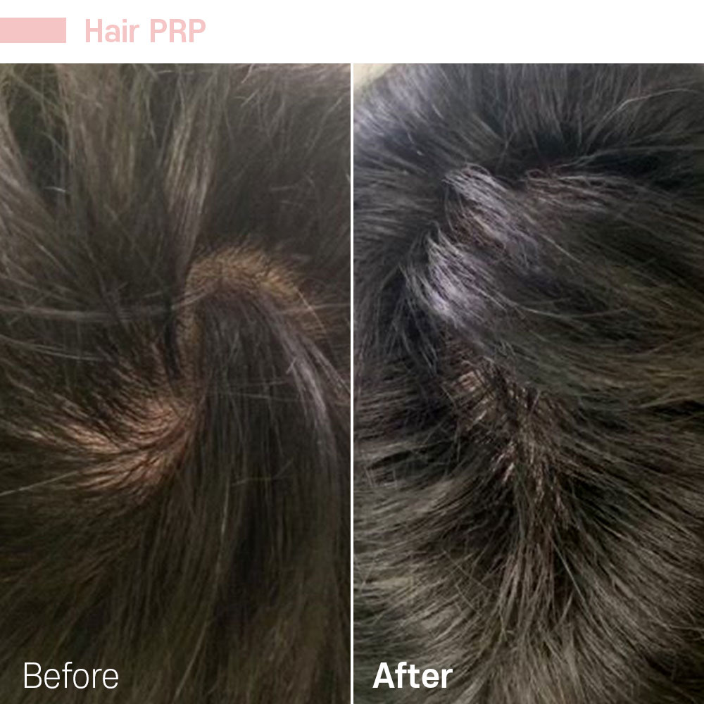 Hair PRP — before and after at Jeune Medspa La Habra