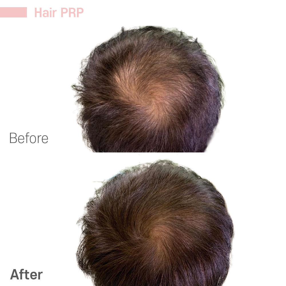 Hair PRP — before and after at Jeune Medspa La Habra