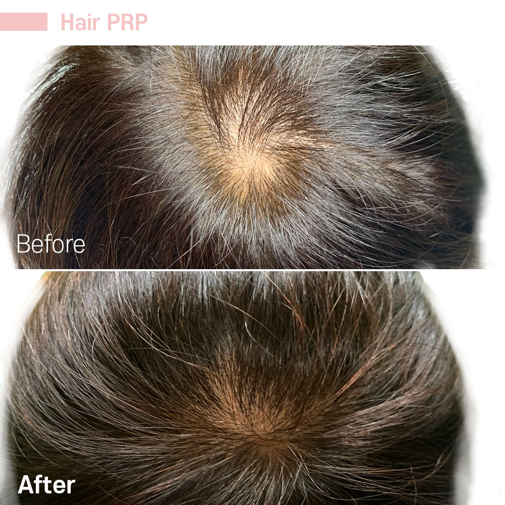 Hair PRP — before and after at Jeune Medspa La Habra