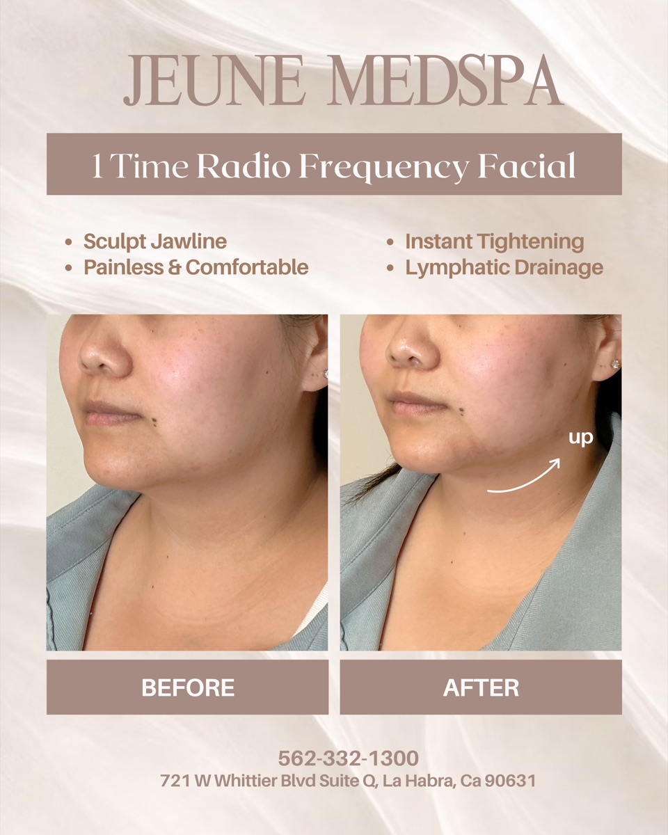 Radio Frequency Facial — 1 Session — before and after at Jeune Medspa La Habra