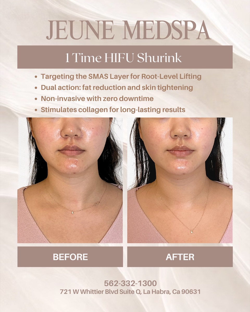 HIFU Shurink — 1 Session — before and after at Jeune Medspa La Habra